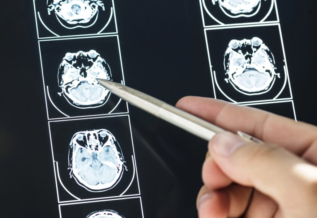 Em busca da cura do meduloblastoma