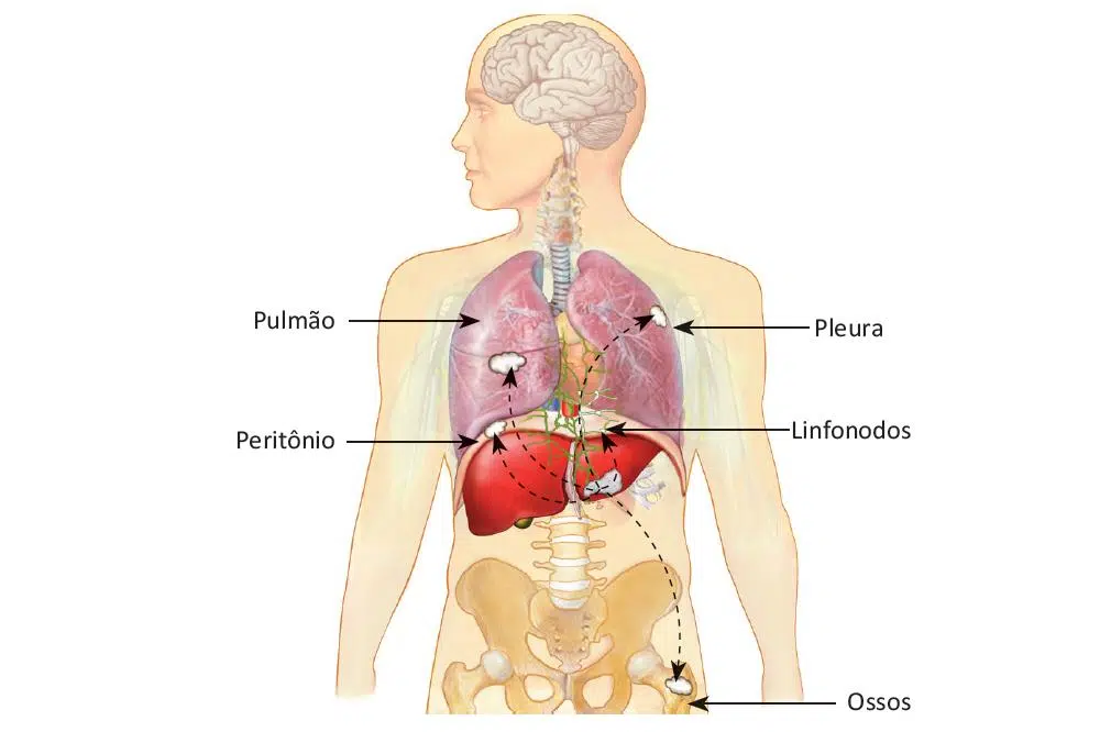O que é câncer de fígado
