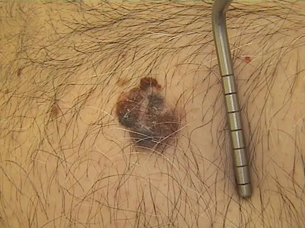 Sintomas do câncer de pele (melanoma e não melanoma)
