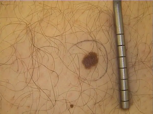 Sintomas do câncer de pele (melanoma e não melanoma)