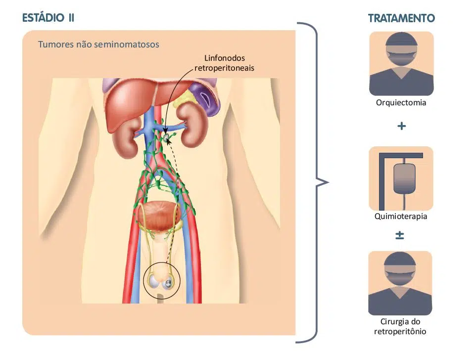 Tratamento do câncer de testículo
