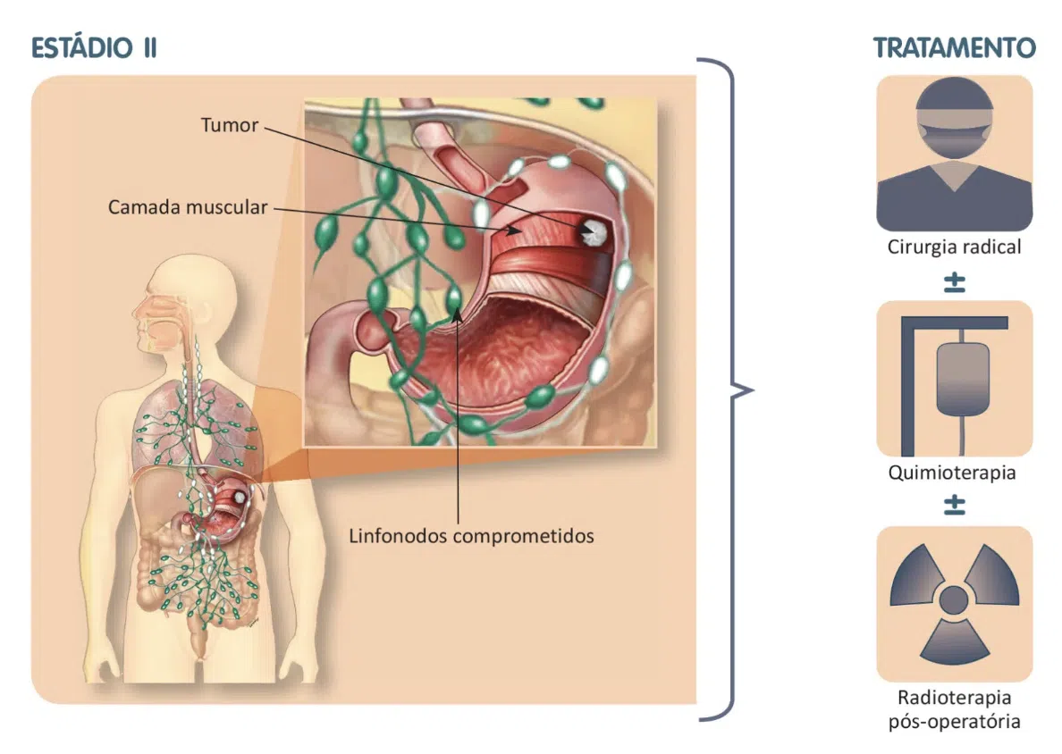 tratamento do câncer de estômago - estádio II