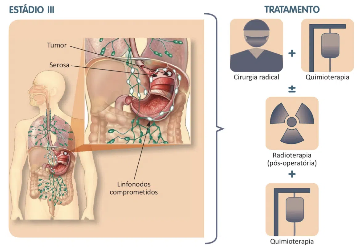 Tratamento do câncer de estômago - Estadio III