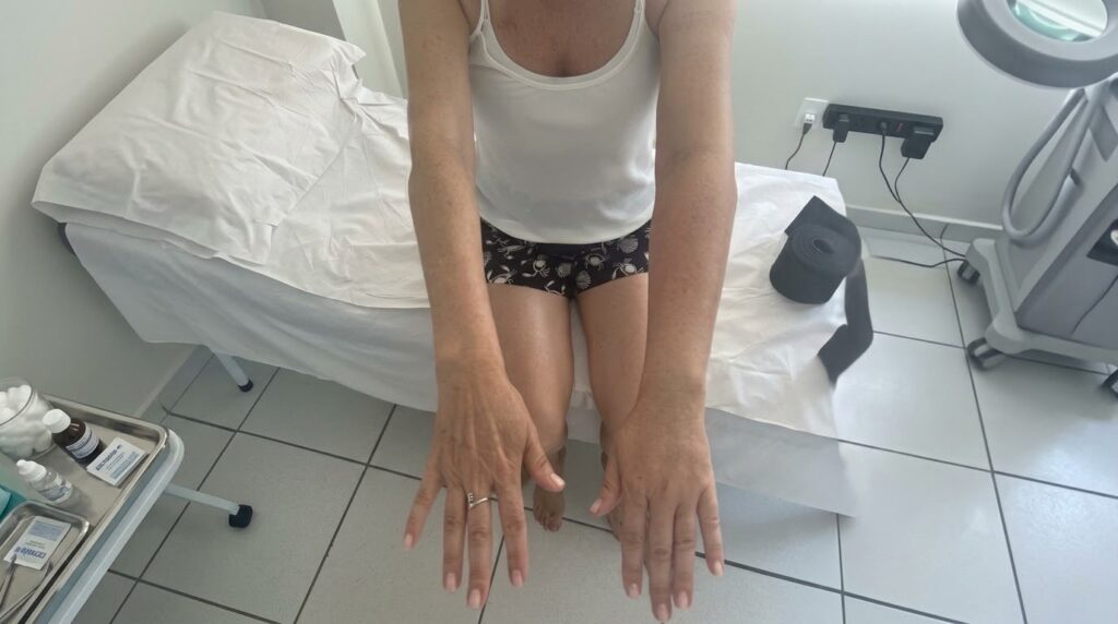 Linfedema no câncer: um cuidado que funciona, e ao qual poucos têm acesso